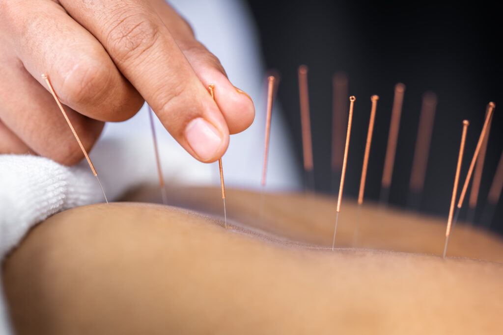 Acupuncture or Chiropractic Care in Tooele, Utah